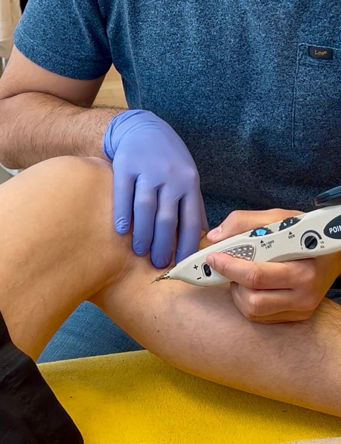 Elektro-Dry-Needling: Stromtherapie-Gerät stimuliert die gesetzte Nadel im Triggerpunkt am Knie