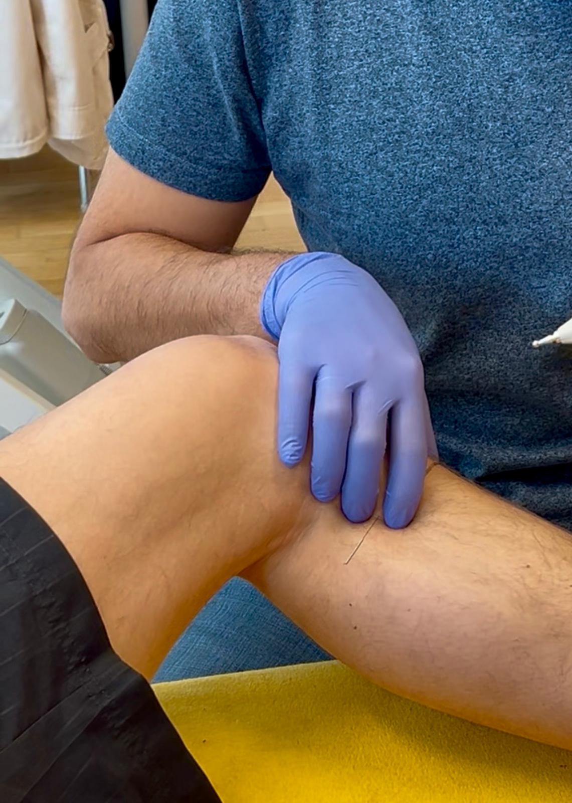 Gesetzte sterile Dry-Needling-Nadel im Muskel oberhalb des Knies